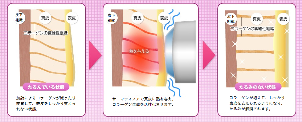 サーマティノアが肌へ働きかけるメカニズム